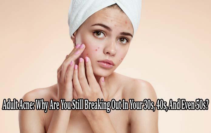 Adult Acne Why Are You Still Breaking Out In Your 30s 40s And Even 50s Ireland Top News 9859