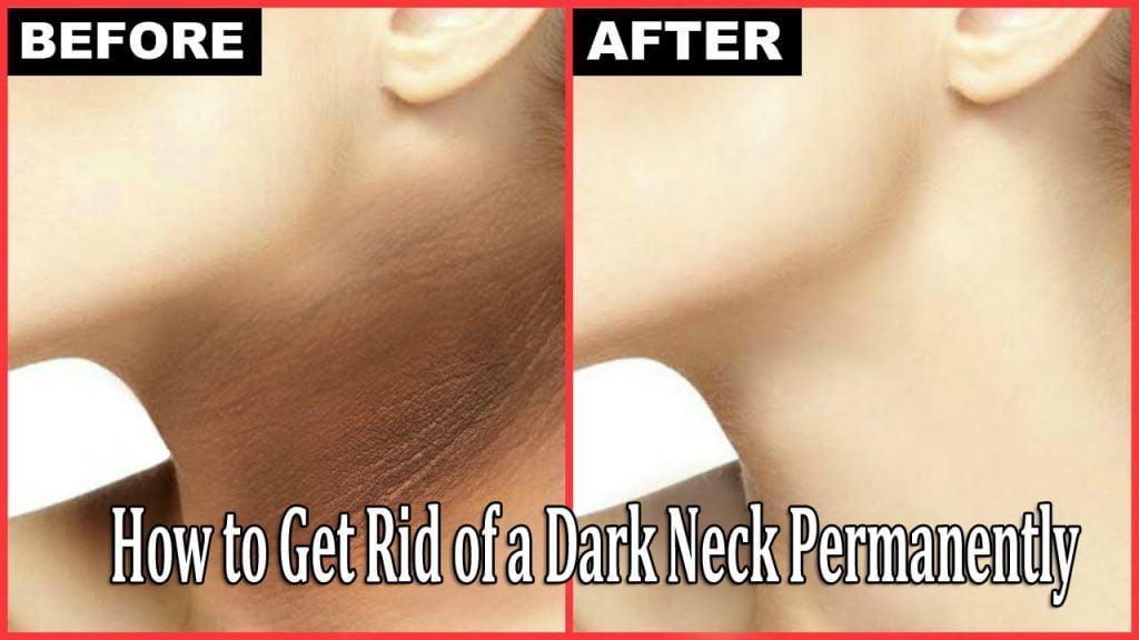 How to Get Rid of a Dark Neck Permanently