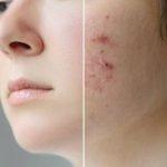 What is the best treatment for pimples and acne?