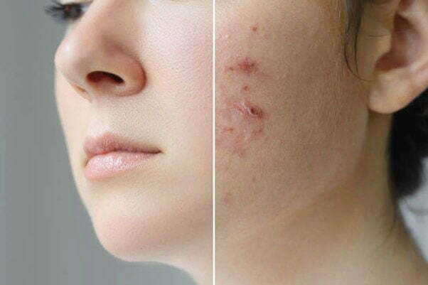 What is the best treatment for pimples and acne?