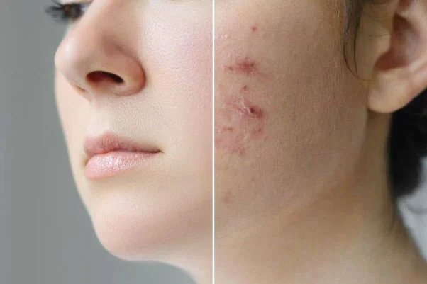 What is the best treatment for pimples and acne?