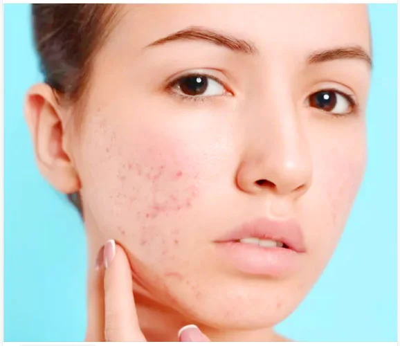 What is the best way to get rid of pimples and dark spots?