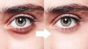 I have very dark circles under my eyes and I tried several creams but none of them worked. What's the best cream in the world?