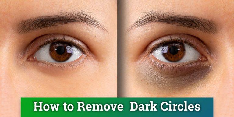 dark circles