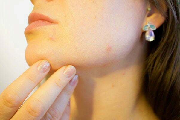 pimples or acne