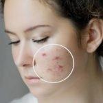 Should I still moisturize my face while I have acne?