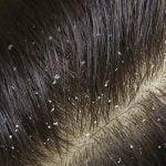 dandruff on my hair