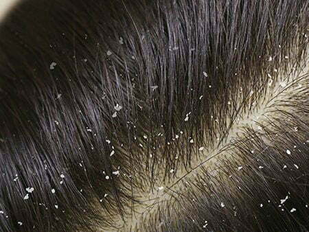 dandruff on my hair