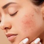 What is acne and what causes it ?