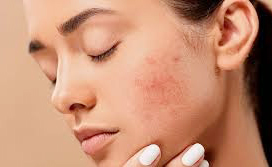 What is acne and what causes it ?