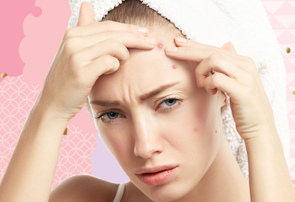 Best practices for preventing and treating acne