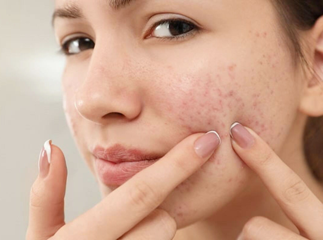 Homemade remedies to treat and help acne