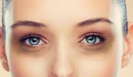 Natural remedies to reduce dark circles under the eyes