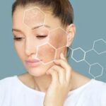 How to Effectively Remove Dark Spots Caused by Acne?