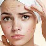 What are some natural ways to get rid of pimples fast?