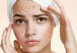 What are some natural ways to get rid of pimples fast?