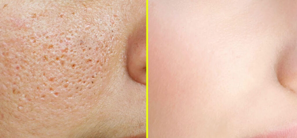 How do you close open Pores Naturally?